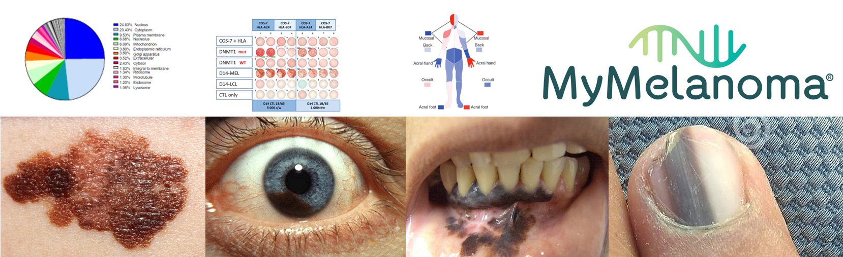 a collection of images showing melanomas